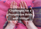 Prospective Vitiligo Leucoderma Bride challenges