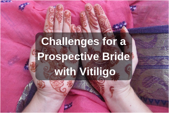 Challenges For A Prospective Bride With Vitiligo Dermamatrimony Matchmaking Blog 9671